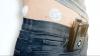 NHS artificial pancreas rollout shows promise, narrows access gap
