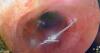Vietnamese doctors remove open safety pin from Kazakh baby’s esophagus