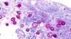 Connecticut reports 23 cases of cyclosporiasis as health officials urge produce washing