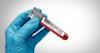 LA County Public Health confirms another case of measles