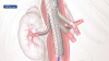 Oklahoma City hospital offers new treatment for aortic aneurysms