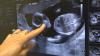AI-powered ultrasound system aims to bridge gap in maternity care deserts