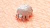 UK hospital forced to close after outbreak of crusted scabies spreads among patients