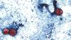 Cyclosporiasis cases rising in NYC, health officials say