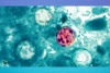 Georgia Department of Public Health and Statesboro Urgent Care provide guidance on Cyclospora parasite