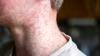 Delaware health officials on high alert as measles cases rise in PA