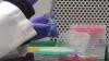 LP(a) screening may help detect inherited heart disease risk