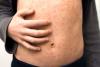 Wyoming health officials confirm second measles case, possible exposure at Grand Teton Park