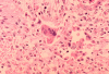 Measles Outbreak Nears 30-Year US Record as Virginia Becomes New Hot Spot