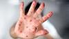 Monkeypox in Costa Rica