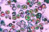 U.S. Measles Cases Reach Over 2,200—Nearly Totaling All Measles Cases Recorded In 2025