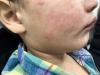 Tennessee Health Department Confirms Two Measles Infections in Middle Tennessee