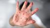 Measles Resurgence in the United States Raises Alarm Over Vaccine Misinformation and Public Health Cuts