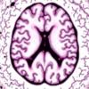 Clinicopathologic Study Reveals Amyloid Clearance in Alzheimer’s Disease