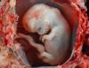 Missouri Heads to State Supreme Court to Defend Pro-Life Laws
