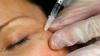 Zombie filler: Dead people's fat is the latest beauty trend