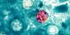 SAFETY ALERT: ‘Explosive’ diarrhea illness spreads to Georgia, South Carolina