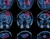 Oral Alzheimer's Drug Enters Human Record With First Anti-Neuroinflammation Signal