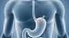 Why Patients Are Traveling to Europe for RefluxStop – Next-Generation GERD Surgery