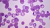 Cyclospora outbreak tops 2,600 US cases: Doctor explains how the parasite spreads