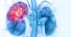 Chronic kidney disease now ninth leading cause of deaths globally — Lancet study