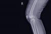 Japanese researchers figure out mechanics behind rare bone cancer