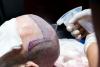 2026: 10 reputable hair transplant clinics in Turkey for UK Patients: Safety and Licensing