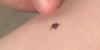 Tick season is raising alarms in 2026. What Alabama pet owners should know