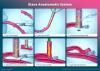 A breakthrough in coronary bypass surgery: AMT Medical’s SAFE-CAB results published in The Journal of Thoracic and Cardiovascular Surgery 