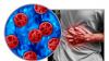 Wisconsin Department of Health Services reports 61 cases of Cyclospora, most linked to travel