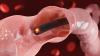 Population-Wide CRC Screening May Cut Health Inequities