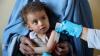 UNICEF: 3.7 Million Children in Afghanistan at Risk of Severe Malnutrition