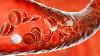 Can plastic pollution trigger heart attacks? New study finds strong link between microplastics and heart health