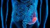 How colon cancer spreads: Scientists uncover ‘identity switch’ behind deadly metastasis