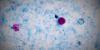 Cyclospora outbreak grows in Missouri and Illinois as investigators continue search for source