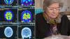 Australian dementia patient backs World Health Organisation recommendations on how to halve cases