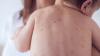 Delaware officials confirm 1st case of measles in more than a decade