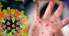 Delaware confirms first measles case in more than a decade