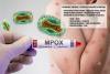 Health Ministry Confirms Third Mpox Case in Costa Rica: Patient Resides in Heredia