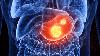Noncardia Gastric Cancer Risk Higher in Some Ethnic Groups