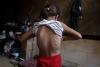 Chickenpox surges in Gaza camps amid overcrowding and poor sanitation