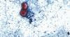 Louisiana Cyclospora Cases Surge in Past Week, with New Hospitalizations