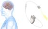 China's first subdural flexible implantable BCI gains fast-track approval pathway