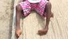 Overcoming Cultural stigmas: The ongoing fight against Clubfoot in Western Cameroon