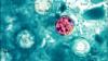 Washoe County logs first 2026 cyclosporiasis case; illness likely tied to Midwest travel