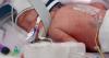 After an extremely rare pregnancy, an Australian woman gives birth to identical quadruplet girls