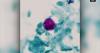 Cyclospora outbreak: 46 cases in New Jersey, 28 in Pennsylvania, including 5 cases in Bucks Co.