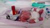 Australian mother of four gives birth to identical quadruplet girls