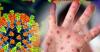 Delaware declares measles outbreak after four confirmed cases