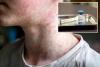 US hits most cases of ‘world’s most contagious disease’ in 35 years — and it’s only July